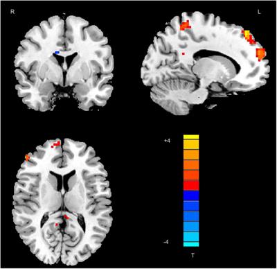 Abnormal hubs in global network as neuroimaging biomarker in right temporal lobe epilepsy at rest